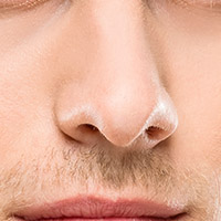 Nasal Valvoplasty (Non-surgical)